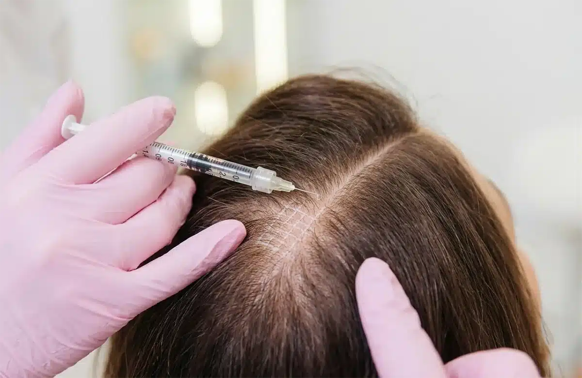 Mesotherapy for hair loss in Dubai