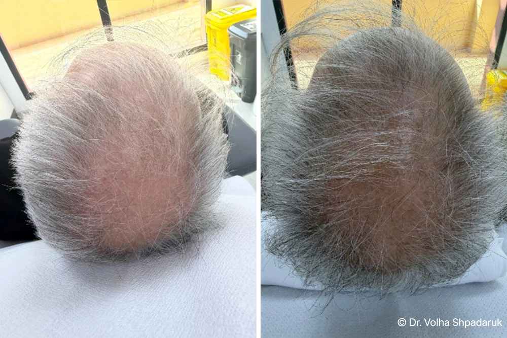 Hair Loss Treatment in Dubai - Before & After