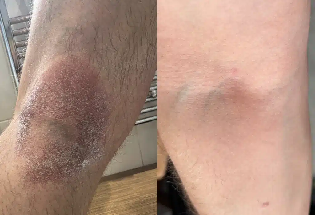 Eczema Treatment Before After