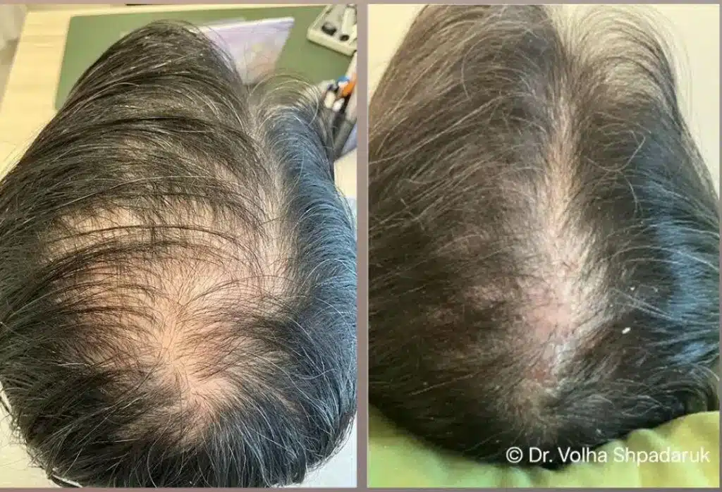 Hair Loss Treatment Dubai