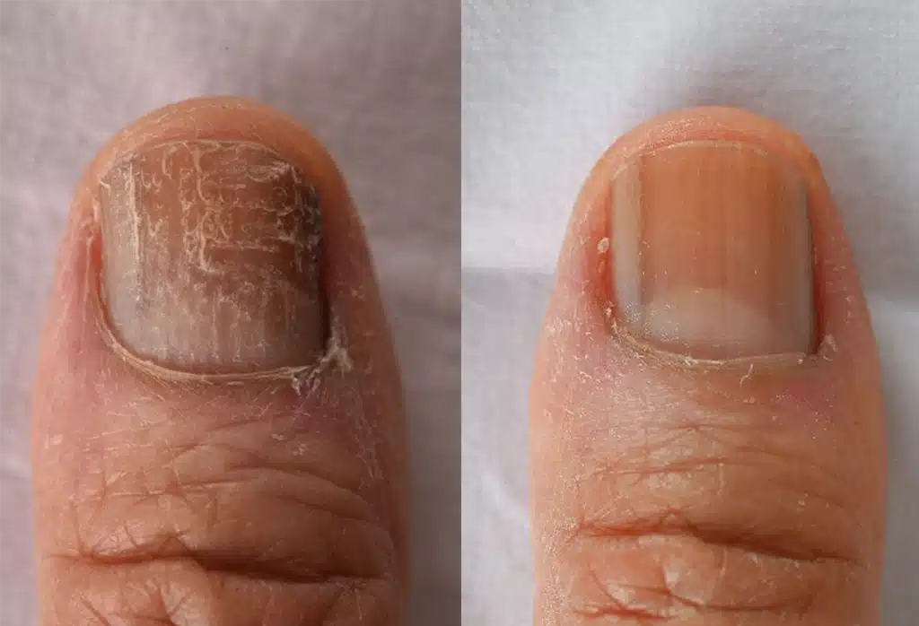 Nail Infection Treatment
