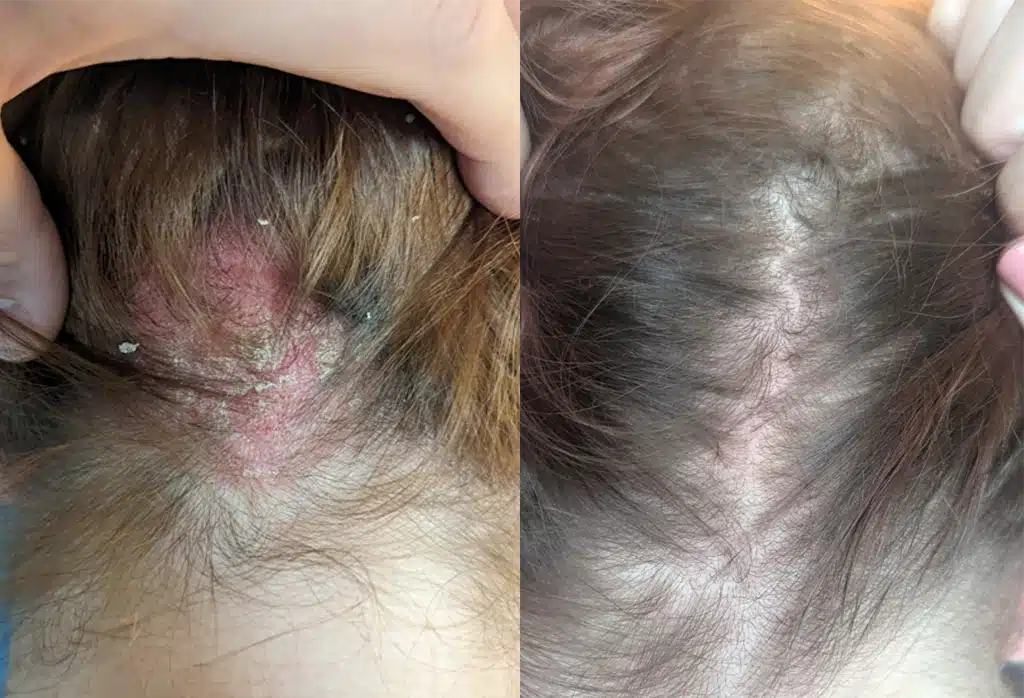 Scalp Psoriasis Treatment
