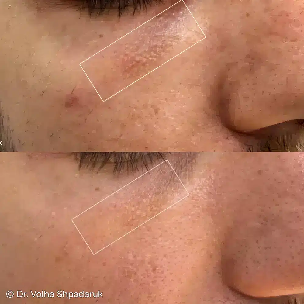 Undereye Filler Dissolve Before After