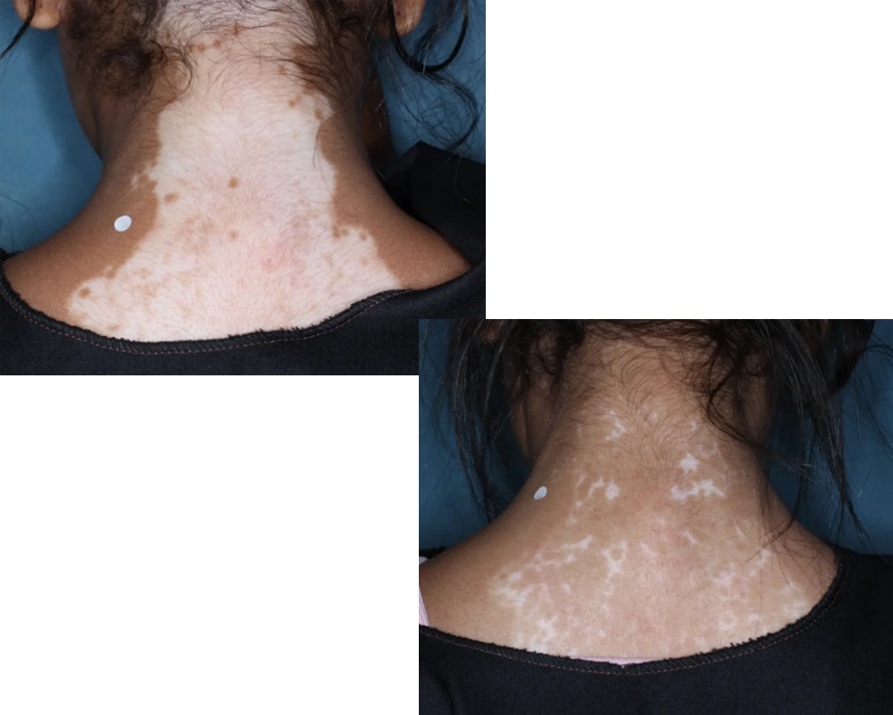 Before After of Vitiligo Treatment with Cream after 6 Months