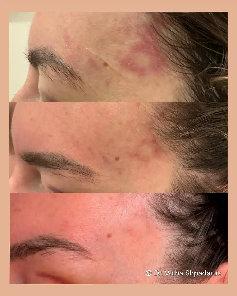 Filler Dissolve with Ultrasound in Dubai with Dr Volha Shpadaruk
